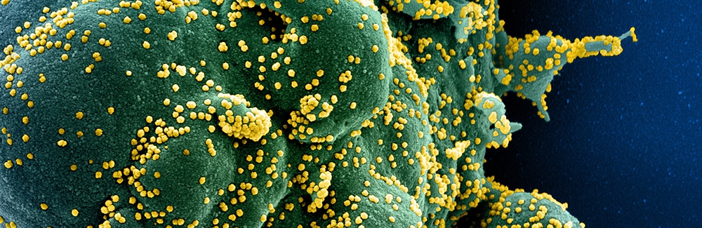 Colorized scanning electron micrograph of an apoptotic cell (green) heavily infected with COVID-19 virus particles (yellow), isolated from a patient sample. Image captured at the NIAID Integrated Research Facility (IRF) in Fort Detrick, Maryland. Credit: NIAID