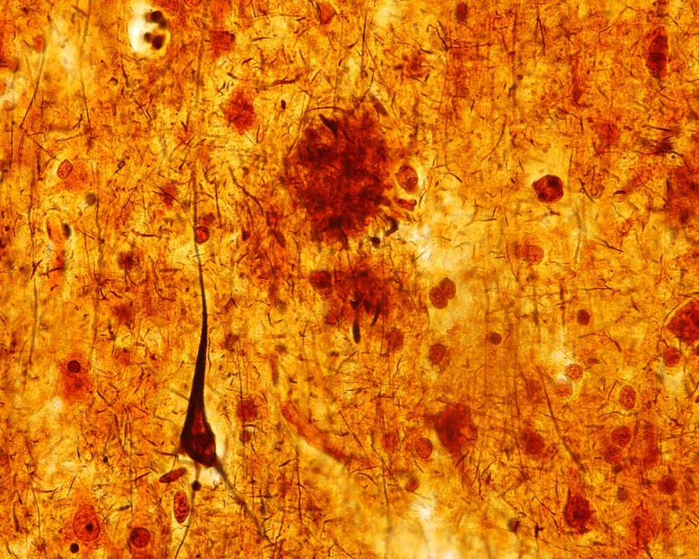 This light micrograph from the brain of someone who died with Alzheimer's disease shows the plaques and neurofibrillary tangles that are typical of the disease.